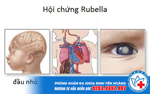Một số tác hại của việc nhiễm Rubella khi mang thai