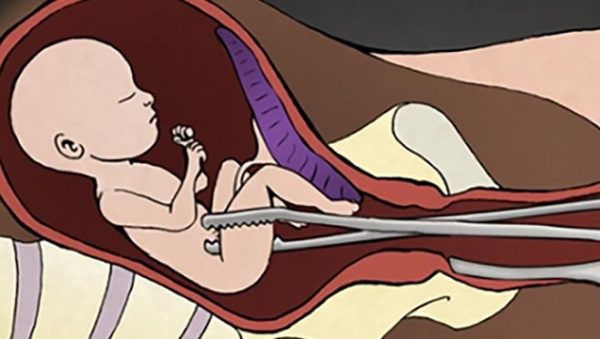 Nong gắp thai tất tần tận quá trình an toàn không đau