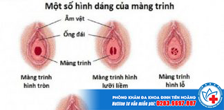 Dấu hiệu nhận biết màng trinh tự nhiên bị rách