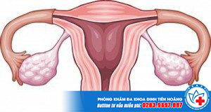 Dính tử cung vẫn có thai - Có hay không? Sự thật bạn cần biết