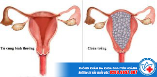 Nguyên nhân chửa trứng - Nhận biết qua các dấu hiệu