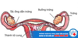 Tắc vòi trứng có biểu hiện gì? có chữa dứt điểm được không?