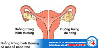 Buồng trứng đa nang là gì?
