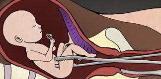 Nong gắp thai tất tần tận quá trình an toàn không đau