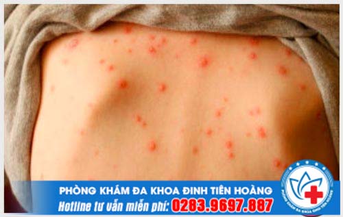 Chia sẻ người bị thủy đậu rồi có bị lại không? 