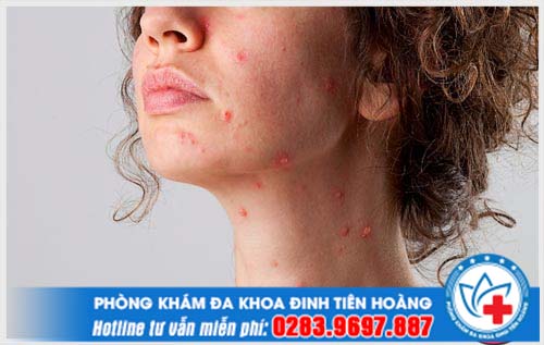 Chia sẻ người bị thủy đậu rồi có bị lại không? 