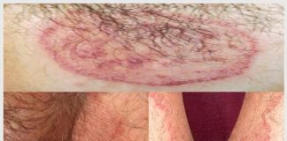 Dấu hiệu nhận biết bị hắc lào ở bộ phận sinh dục