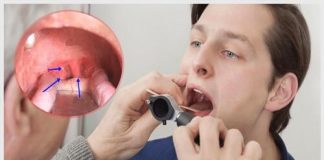 Sùi mào gà ở họng – Hình ảnh nhận biết và cách chữa trị