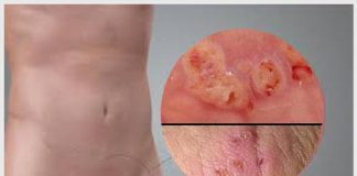 Bị nổi cục ở vùng kín nam giới là hiện tượng gì?