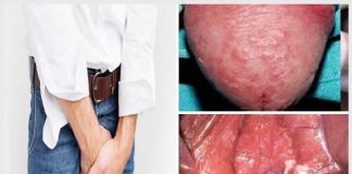 Nguyên nhân và cách chữa trị đau dương vật sau quan hệ