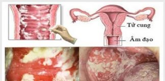 Chia sẻ hình ảnh viêm âm đạo ở bộ phận sinh dục nữ