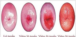 Một số hình ảnh viêm lộ tuyến cổ tử cung rõ nét