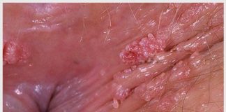 Sùi mào gà ở hậu môn có nguy hiểm không? Chữa bệnh hiệu quả