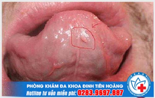 Sùi mào gà ở lưỡi có biểu hiện như thế nào? Cách điều trị