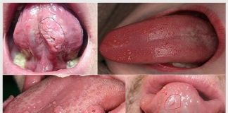 Sùi mào gà ở lưỡi có biểu hiện như thế nào? Cách điều trị
