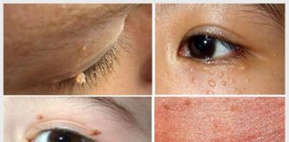Tìm hiểu cách điều trị bệnh sùi mào gà ở mắt an toàn