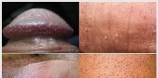 Chia sẻ của chuyên gia về bệnh sùi mào gà ở nam