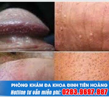 Chia sẻ của chuyên gia về bệnh sùi mào gà ở nam