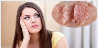 Bệnh sùi mào gà ở nữ giới và cách hỗ trợ điều trị hiệu quả