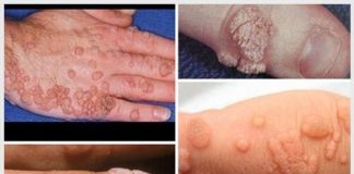 Tìm hiểu triệu chứng sùi mào gà ở tay và cách chữa an toàn