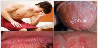 Dấu hiệu viêm dương vật nguy hiểm nam giới cần biết