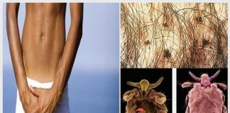 Ngứa vùng lông mu ở nam giới nguyên nhân do đâu? Dấu hiệu cảnh giác