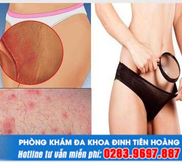 Nổi mụn ở háng là dấu hiệu của bệnh gì? Chữa trị nhanh chóng