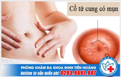 Cổ tử cung có mụn là dấu hiệu nguy hiểm cần chị em cảnh giác