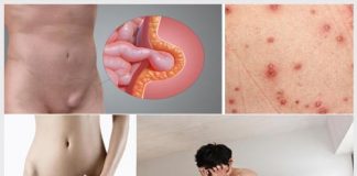 Nổi hạch ở bộ phận sinh dục nam và nữ có nguy hiểm không?