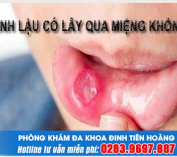 Bệnh lậu có lây qua đường miệng không và triệu chứng chính xác