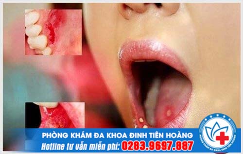 Bệnh lậu có lây qua đường miệng không và triệu chứng chính xác