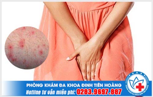 Nấm vùng kín ở nữ và cách phòng tránh bệnh hiệu quả