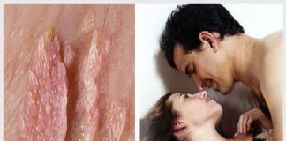 Bị sùi mào gà có quan hệ được không? Lưu ý điều trị