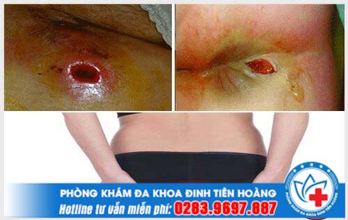 Bệnh rò hậu môn có nguy hiểm không bạn nên biết