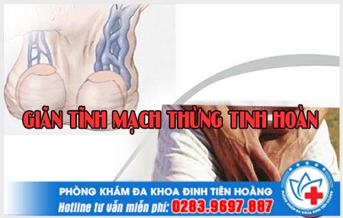 Những nguy hiểm khi nam giới bị giãn tĩnh mạch thừng tinh hoàn