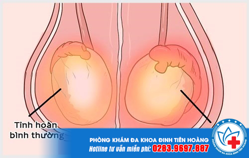 Nam giới cần biết chữa viêm tinh hoàn bao lâu thì khỏi?