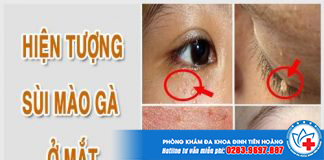hien-tuong-sui-mao-ga-o-mat-1