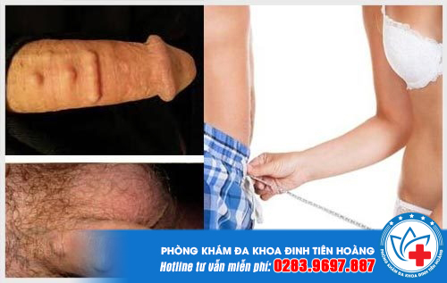 gan-bi-vao-duong-vat-co-tac-dung-gi-1