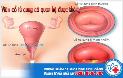 viem-co-tung-cung-co-quan-he-duoc-khong-1-min