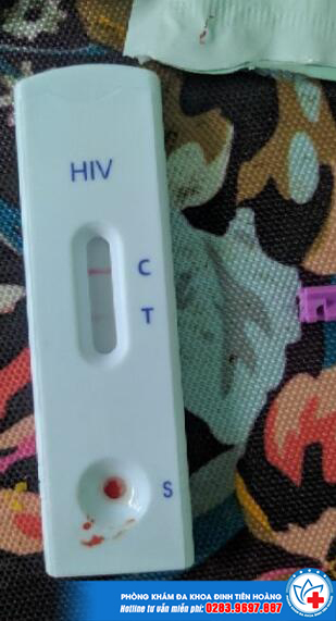 Hình ảnh que thử HIV thể hiện dương tính của bệnh (Hình Thực Tế)